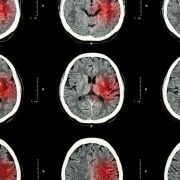 CT scan stroke telestroke